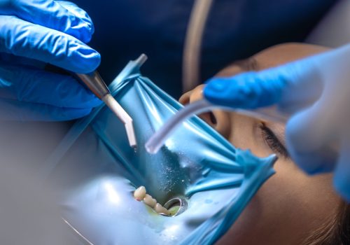 The dentist treats the child's tooth using a rubber dam. Close-up of tooth treatment. High quality photo. Visiting dentist office. Dentistry concept. Installing a rubber dam on the tooth. SSUCv3H4sIAAAAAAAAA41Py47CMAz8F59TKdkWaPMriEMepli0DUoc0KrKv69Sirjubcb2PLwCedBgbX9VQysbb6VvlMJrYwdpGnfqOuzb3h2dBwHeMIJWbdv/HDp57A7DoKSUUoA1iRzoFWiacuJomMICWgqIuHiMG0RPHCKZCbQsAhIbzgkT6LUIcIZxDJE2/vE7r3UOGkBAyraCIv45uwgwIy7ut/qXWmRCs8WdLwLuL8Y479mBb7VihY9IjpZx75QTh/mNl8BVuyVwcHfyu/j9xo0Sh1izID+mYDz6fZ3tTMwfGvFJ+Ppel1L+AGqDHXqEAQAA